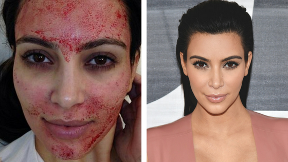 Kim Kardashian 'vampire facial'