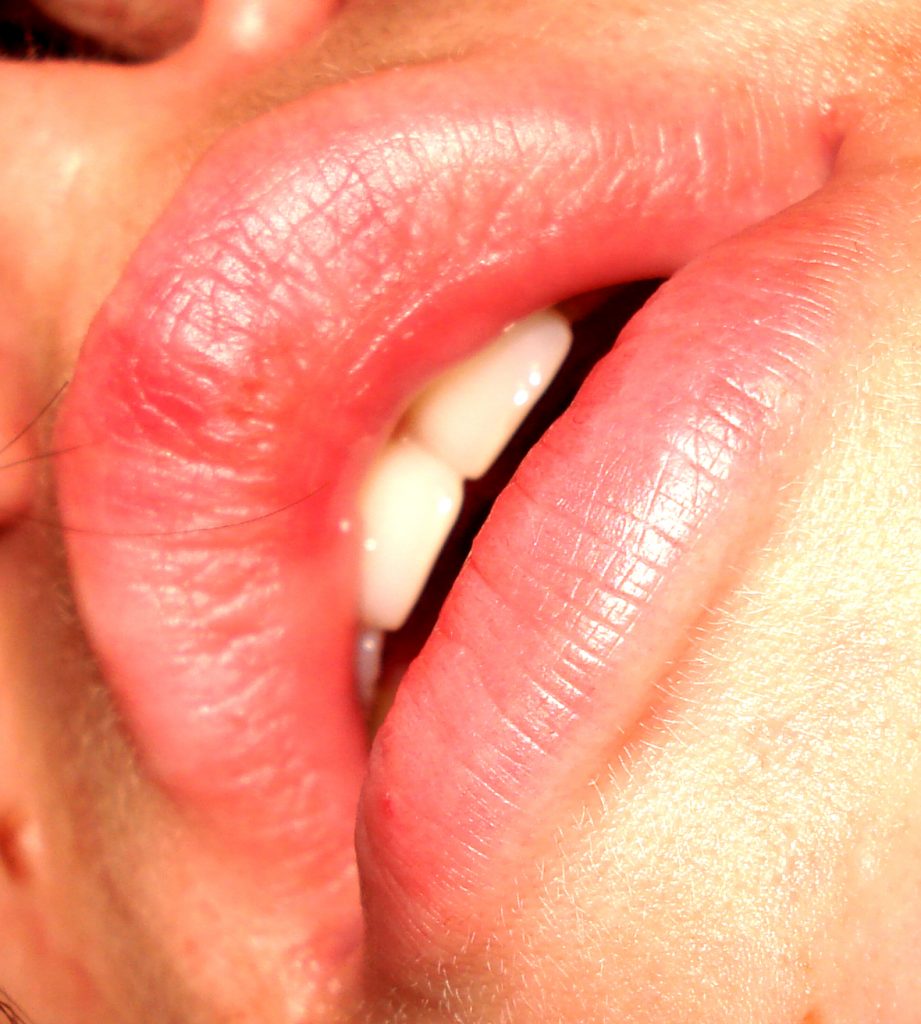 Badly overdone lip filler treatment
